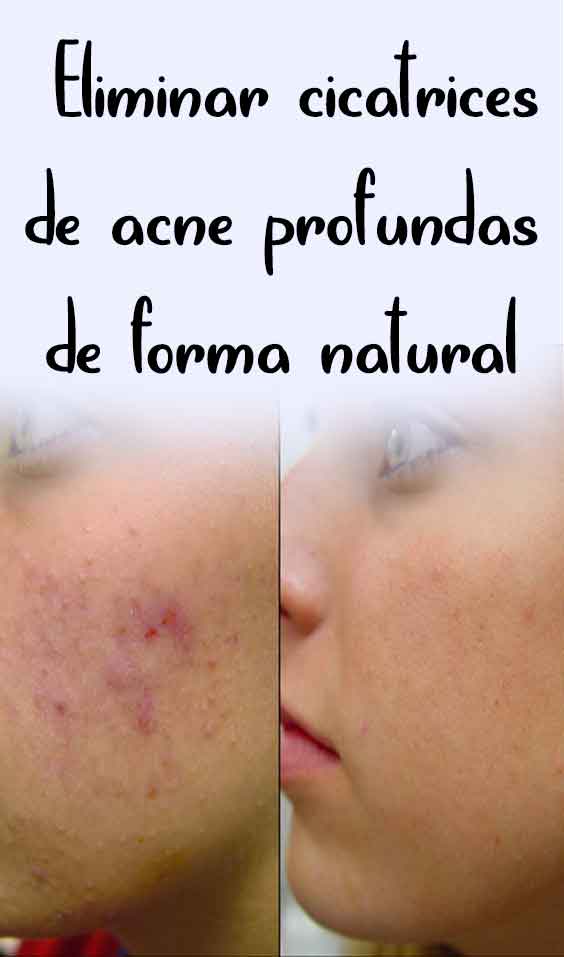 Eliminar Cicatricesde Acne Profundasde Forma Natural